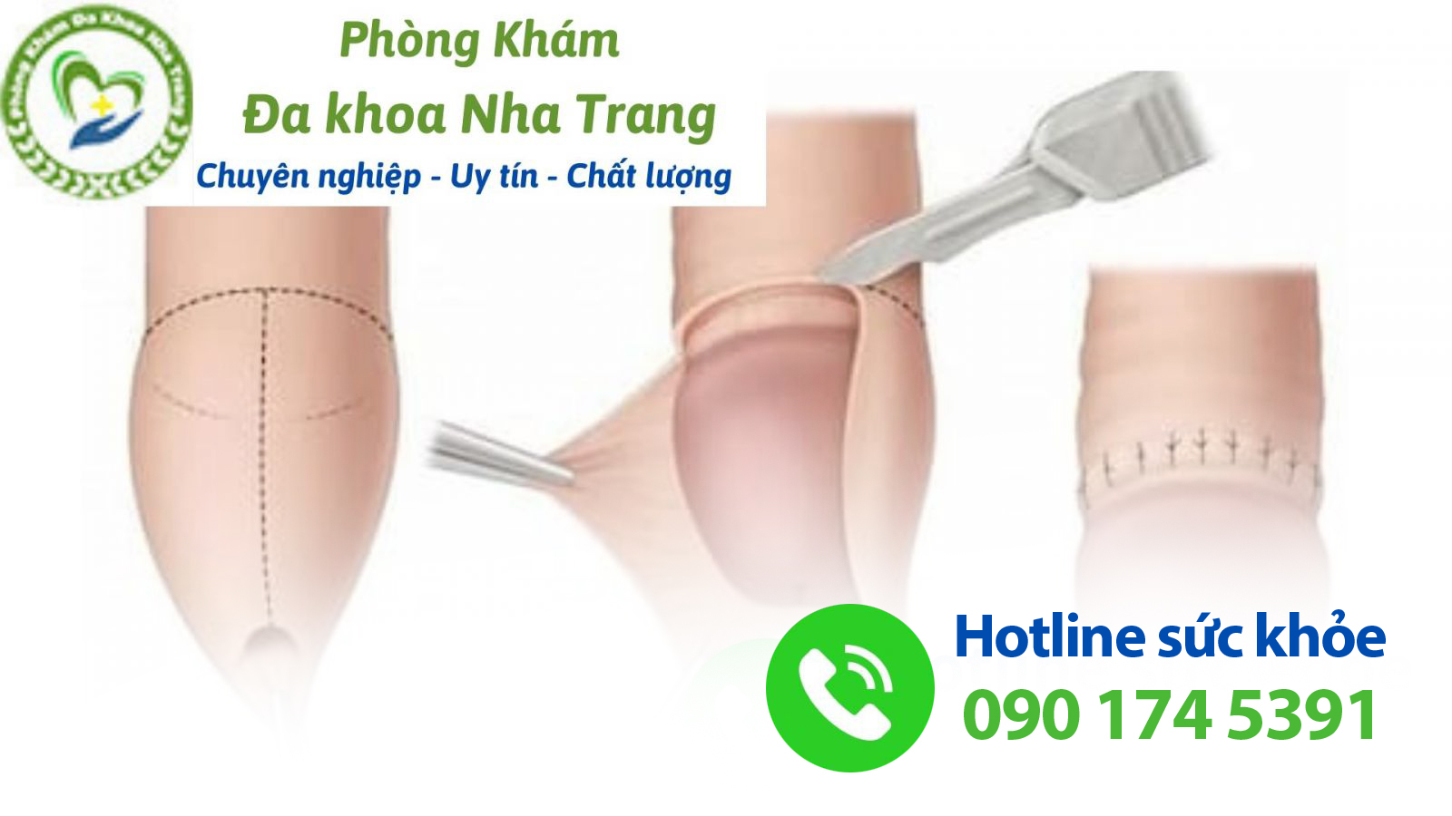  Phương pháp điều trị, cải thiện bán hẹp bao quy đầu hiện nay