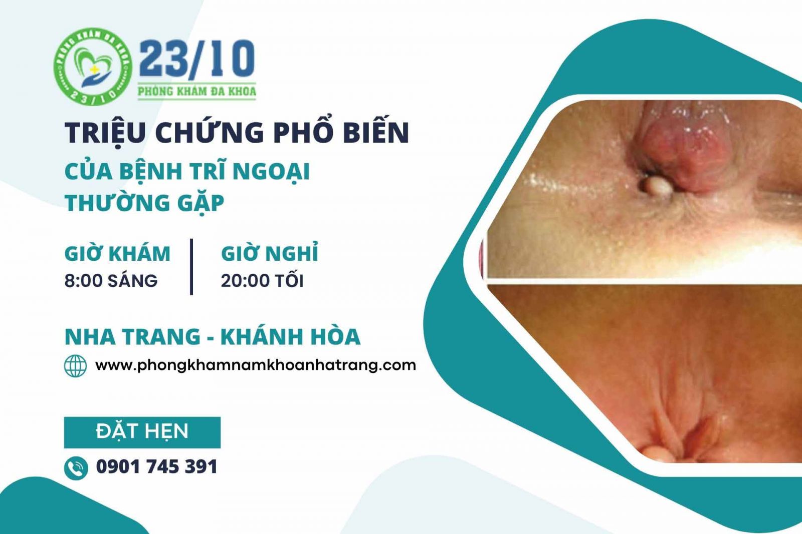 Triệu chứng phổ biến của bệnh trĩ ngoại thường gặp