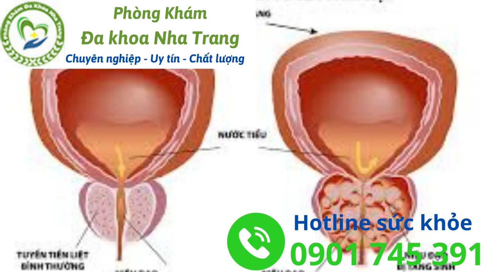 Phì đại tuyến tiền liệt là gì?