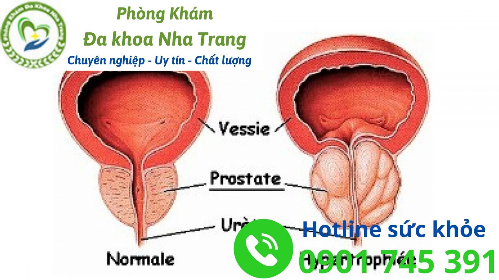 Các triệu chứng phì đại tuyến tiền liệt