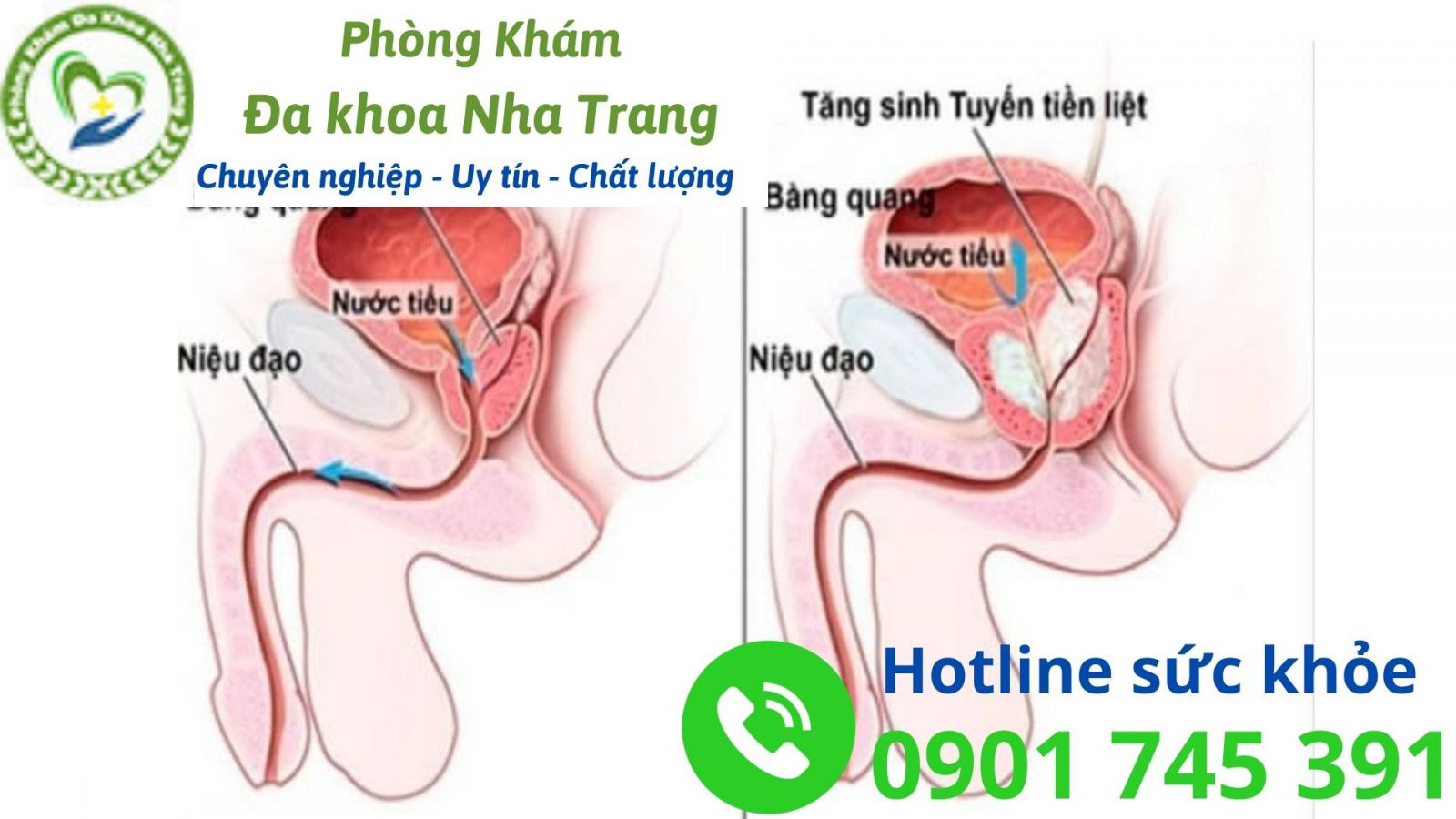 Các bệnh lý liên quan đến tuyến tiền liệt