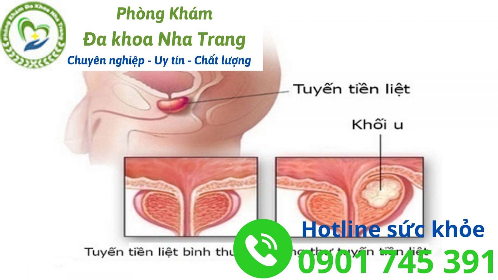 Cách phòng ngừa và bảo vệ sức khỏe tuyến tiền liệt ở nam giới