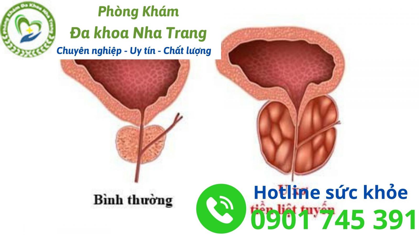 U xơ tuyến tiền liệt là bệnh gì?