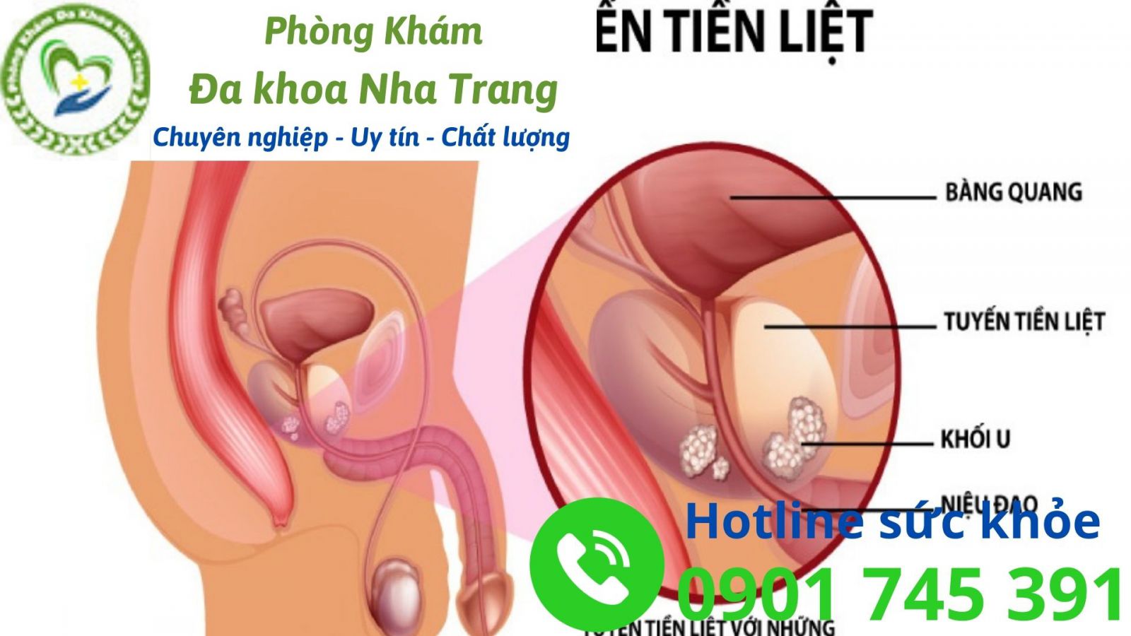 Ung thư tuyến tiền liệt là gì? Các giai đoạn cụ thể