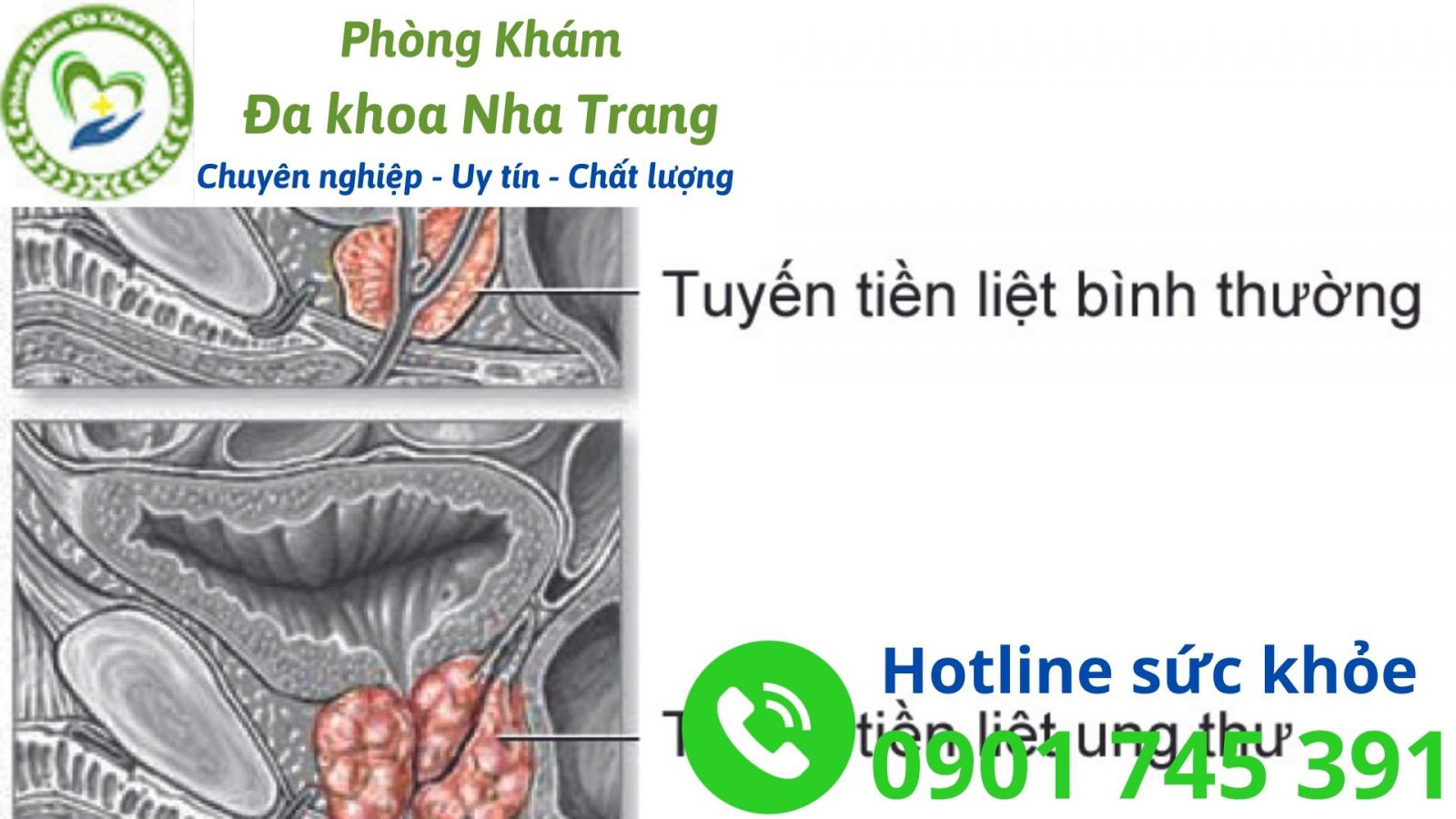 Dấu hiệu nhận biết ung thư tuyến tiền liệt